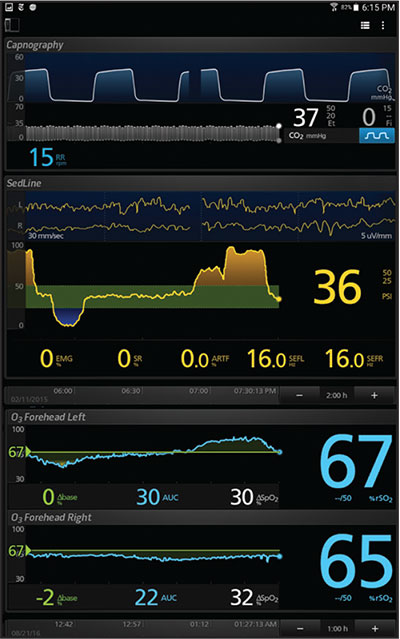 Masimo Kite displaying data from modules connected through the MOC-9 port